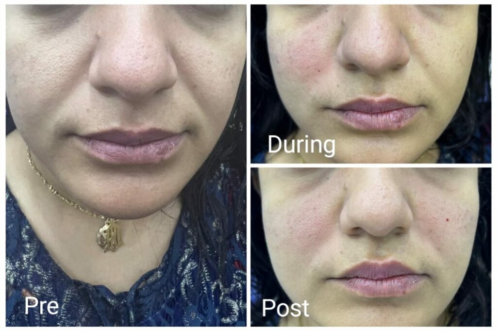 حقن الخدود بالهيالورونيك